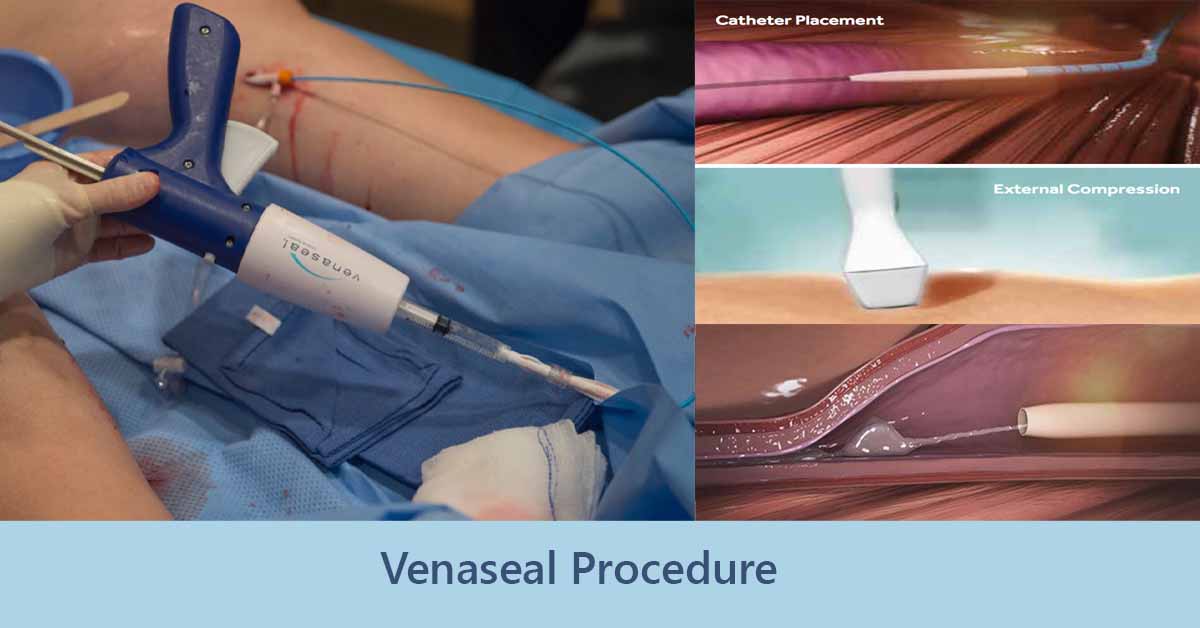 Venaseal Procedure